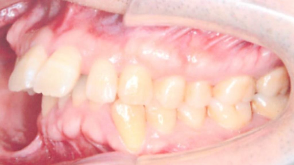 歯科矯正　出っ歯治療前　左前方より