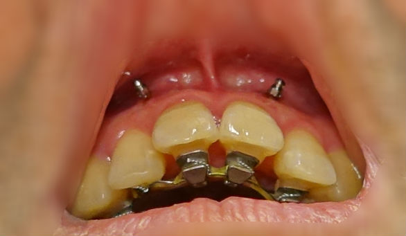 上あご切歯上　12間　アンカースクリュー　歯科矯正
