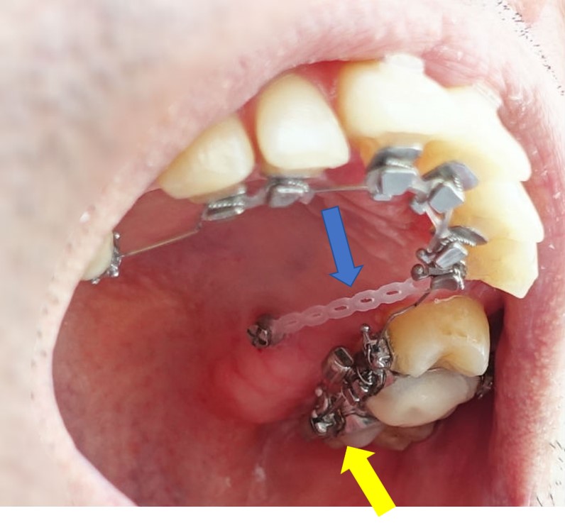 歯科矯正　一か月後　左上顎内側の様子