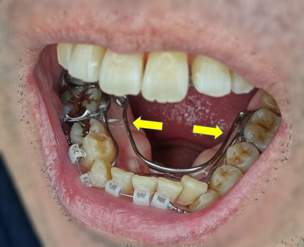 歯科矯正三か月後 下の歯外側矯正装置と内側の金属ばね