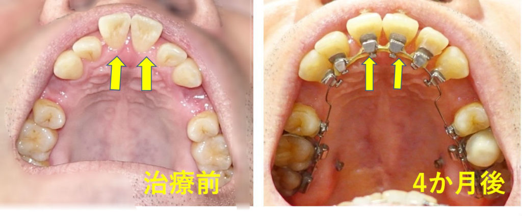 矯正歯科　4か月後　出っ歯　下から見上げた写真
