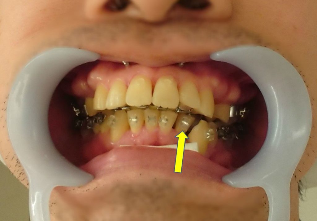 歯科矯正5か月　下左第二切歯にもブラケット接着