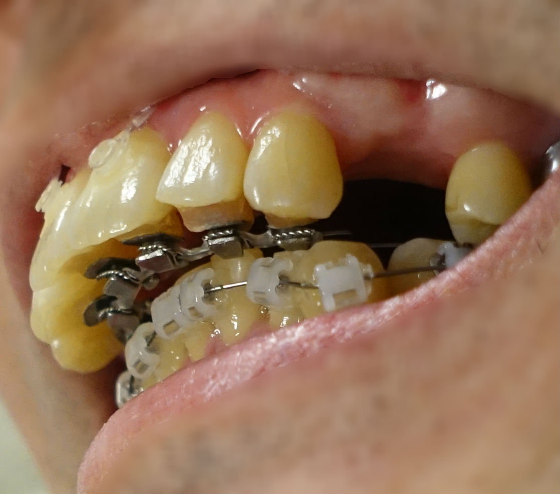 歯科矯正5か月　上下切歯のワイヤー矯正装置　EC