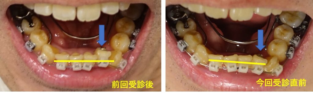 成人歯科矯正　下顎左第二切歯前進
