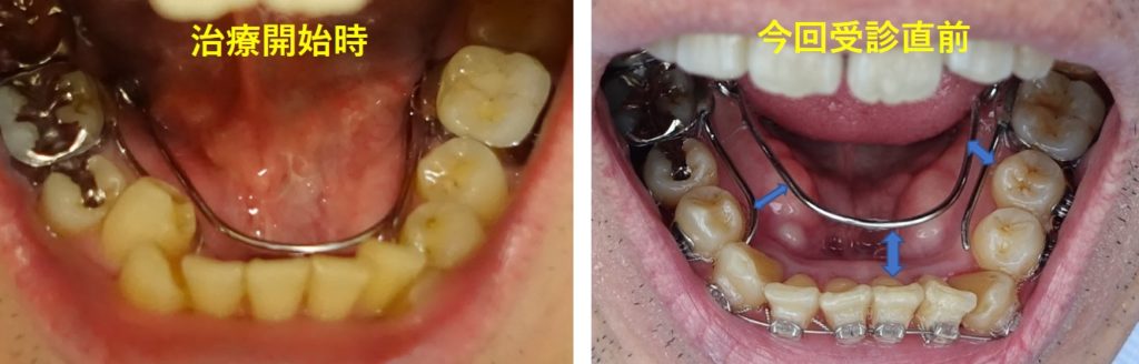成人歯科矯正　下顎臼歯を広げるバネの効果
