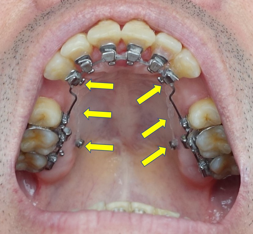 歯科矯正7か月　上顎マイクロインプラント臼歯内側