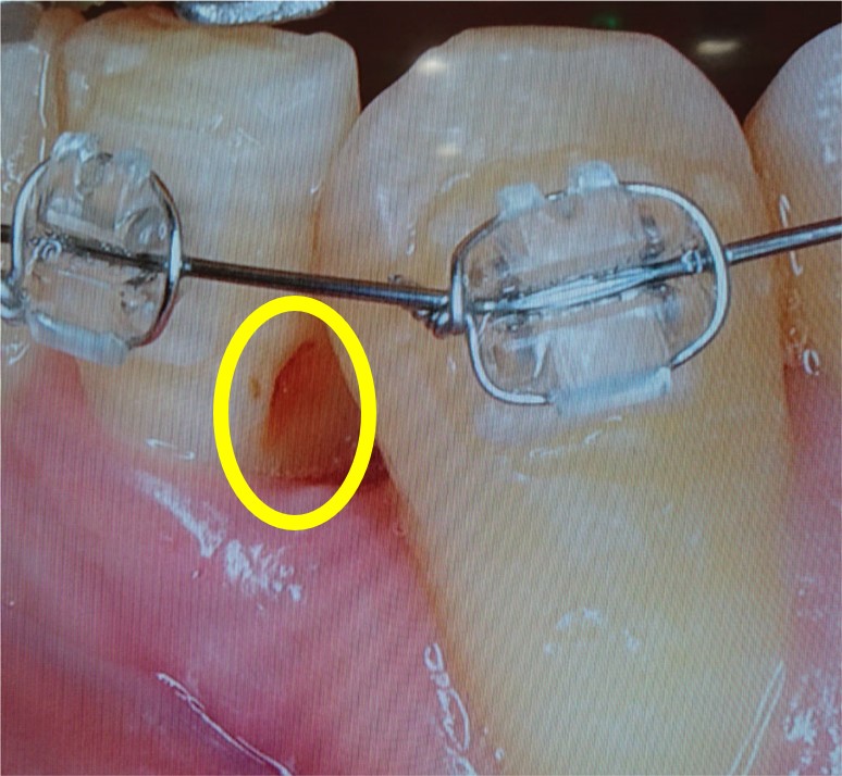 歯科医院にて撮影　左下第二切歯　虫歯
