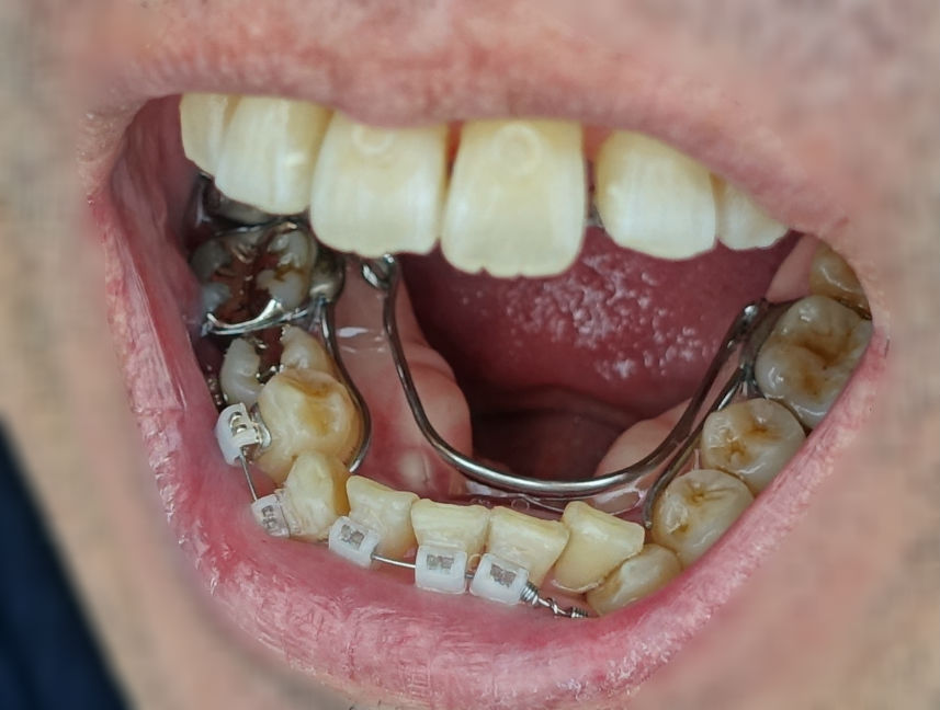 歯科矯正　下あご奥歯を左右に広げるアーチ状針金装置