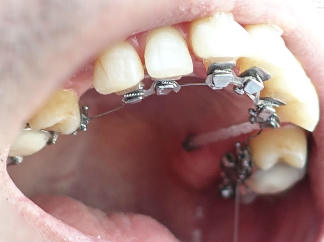歯科矯正　上あご内側の金属製ブラケット