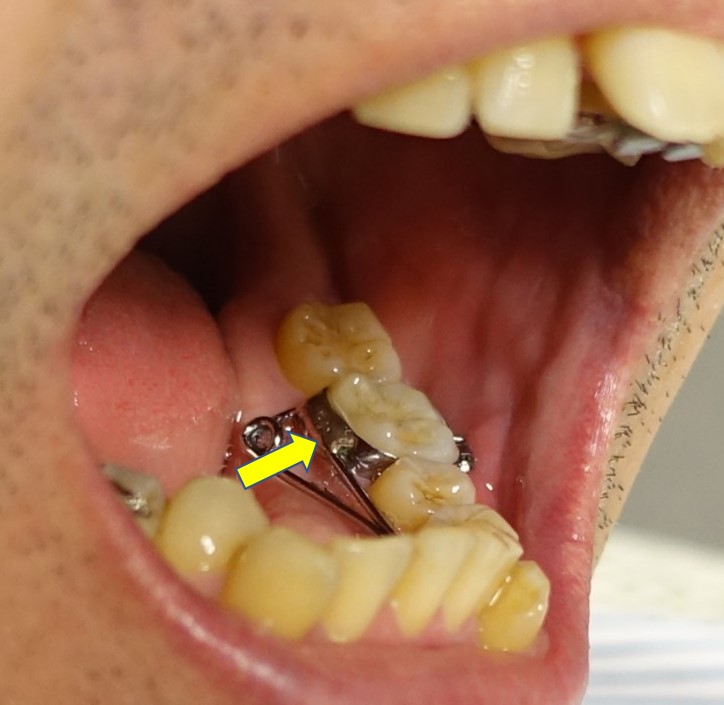 歯科矯正　下顎臼歯のバンド　金属リング