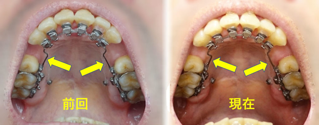 矯正歯科　8か月目　上顎アーチワイヤー交換　太くなる