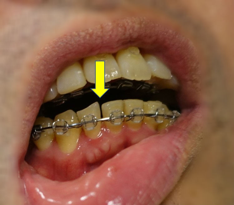 右下第一切歯と第二切歯に隙間