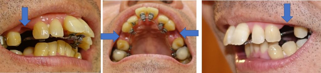治療開始当初　第一小臼歯抜歯後の隙間