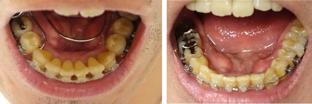 下顎の奥歯広げる装置　10-11か月後