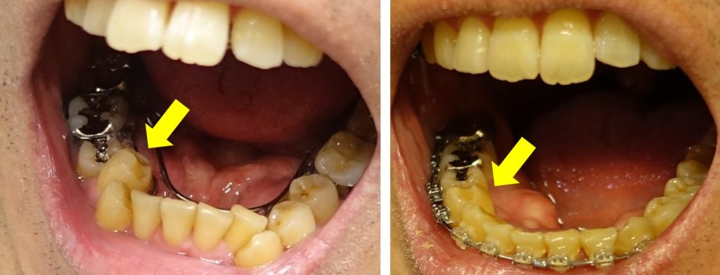 歯科治療13カ月　右第一小臼歯の変化