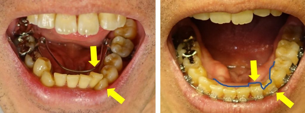 歯科治療13カ月　左下　第二切歯と犬歯の位置の変化