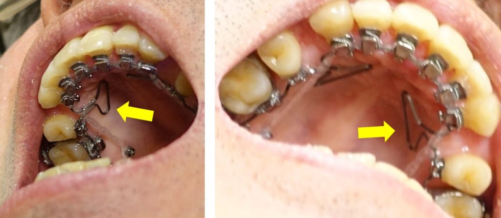 歯科矯正14カ月　上顎アーチワイヤー　Tループ付き　左右別角度