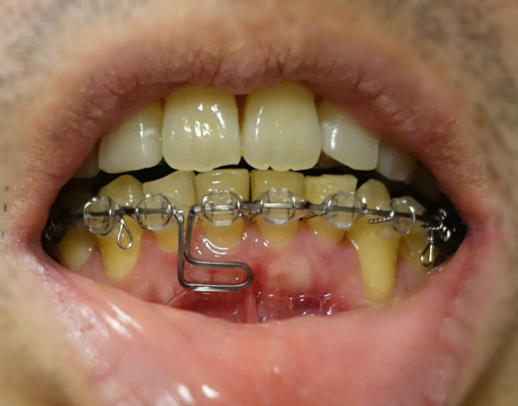 17か月目歯科矯正　下顎アーチワイヤ　ループ付きに変更