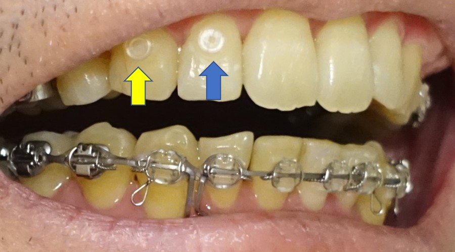 19か月目　右切歯に樹脂製ポッチを追加